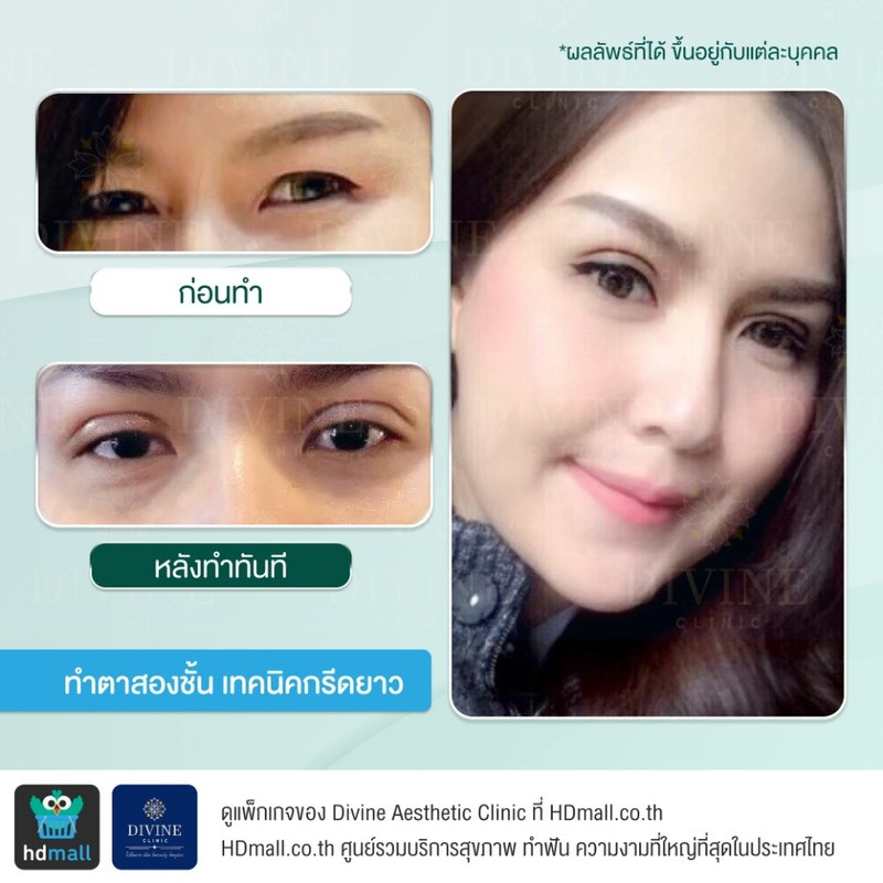 รีวิวทำตา 2 ชั้น เทคนิคกรีดยาว ที่ Divine Aesthetic Clinic
