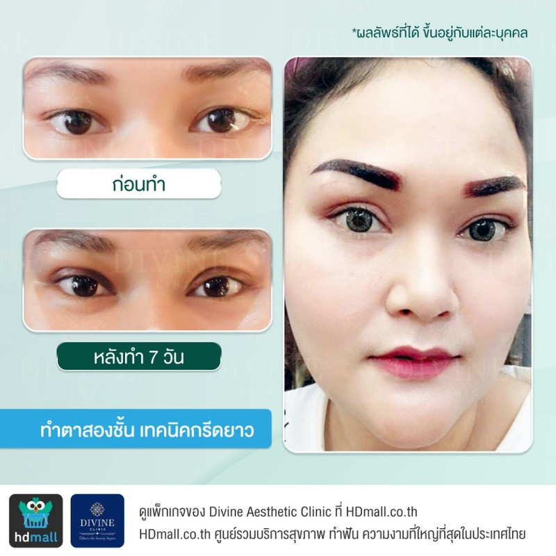 รีวิวทำตา 2 ชั้น เทคนิคกรีดยาว ที่ Divine Aesthetic Clinic