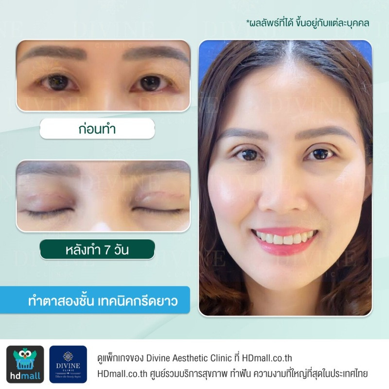 รีวิวทำตา 2 ชั้น เทคนิคกรีดยาว ที่ Divine Aesthetic Clinic