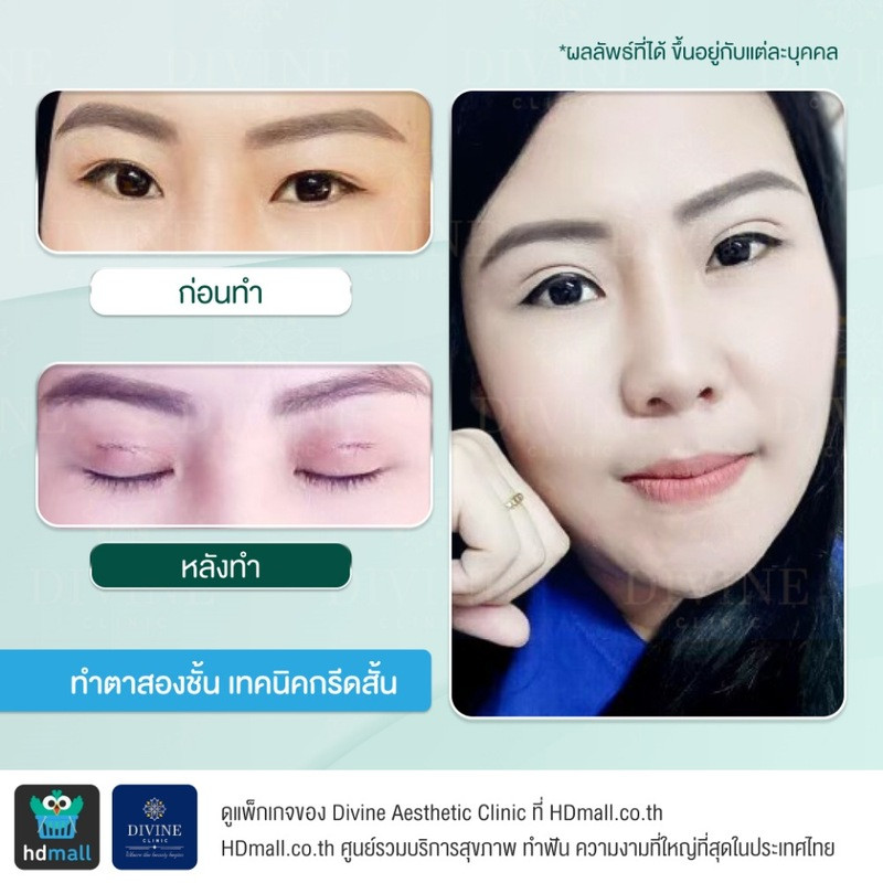 รีวิวทำตา 2 ชั้น เทคนิคกรีดสั้น ที่ Divine Aesthetic Clinic