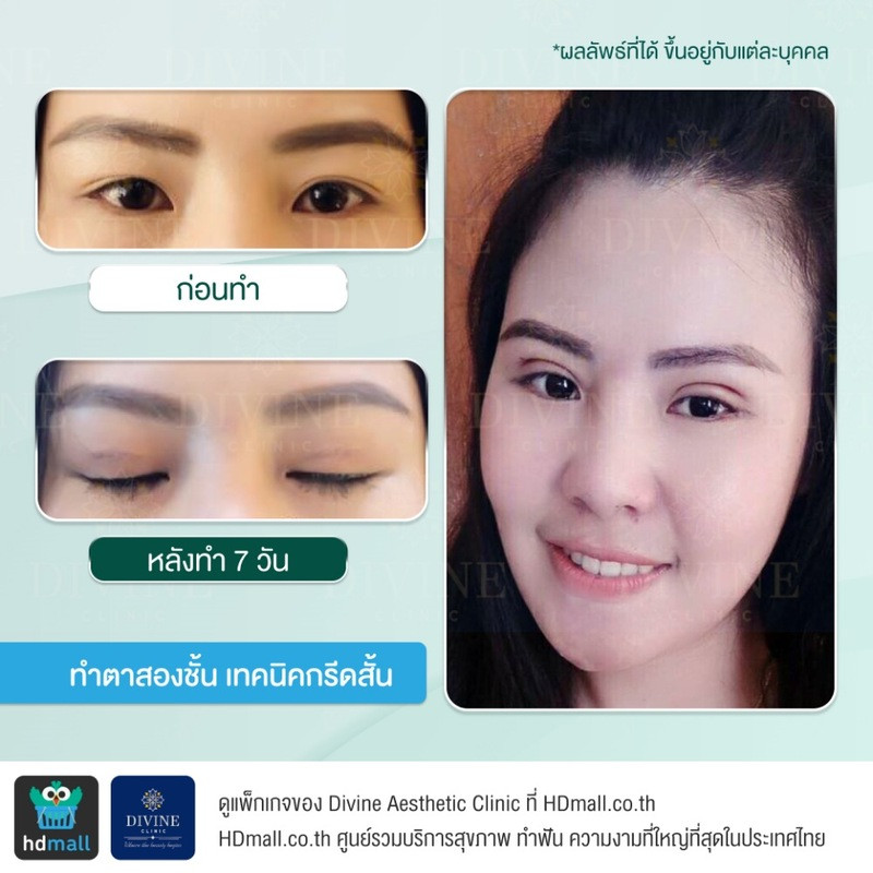 รีวิวทำตา 2 ชั้น เทคนิคกรีดสั้น ที่ Divine Aesthetic Clinic