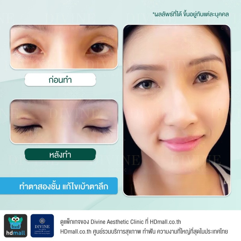 รีวิวทำตา 2 ชั้น เทคนิคกรีดสั้น ที่ Divine Aesthetic Clinic