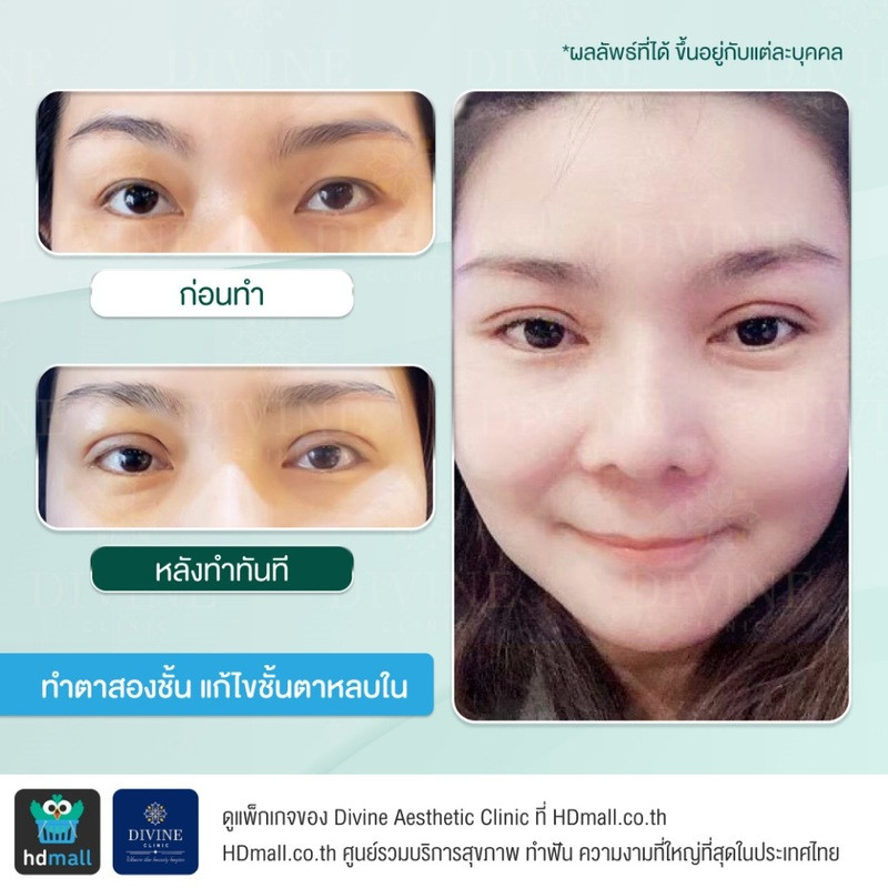 รีวิวทำตาเพื่อแก้ปัญหาต่างๆ ที่ Divine Aesthetic Clinic