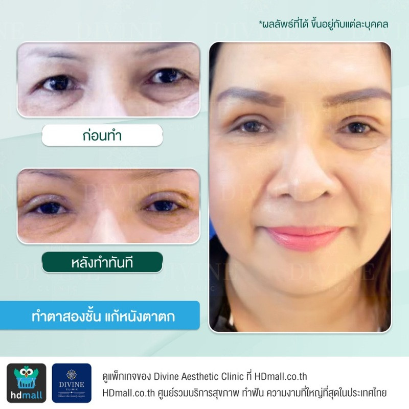 รีวิวทำตาเพื่อแก้ปัญหาต่างๆ ที่ Divine Aesthetic Clinic