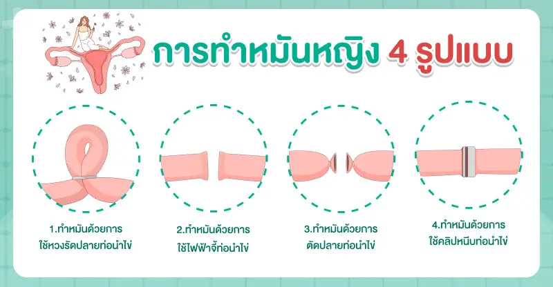 การทำหมันหญิง 4 รูปแบบ