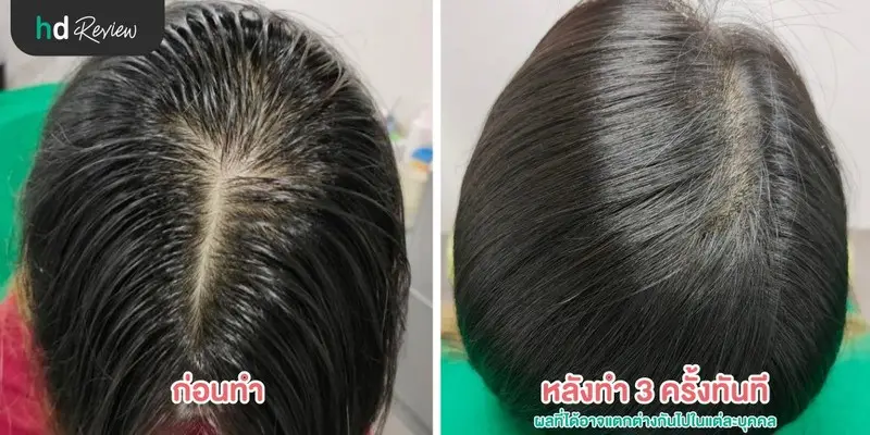 ภาพก่อนและหลังทำเลเซอร์กระตุ้นรากผม หยุดการผมร่วง ครั้งที่ 3 ที่ Grow & Glow Clinic