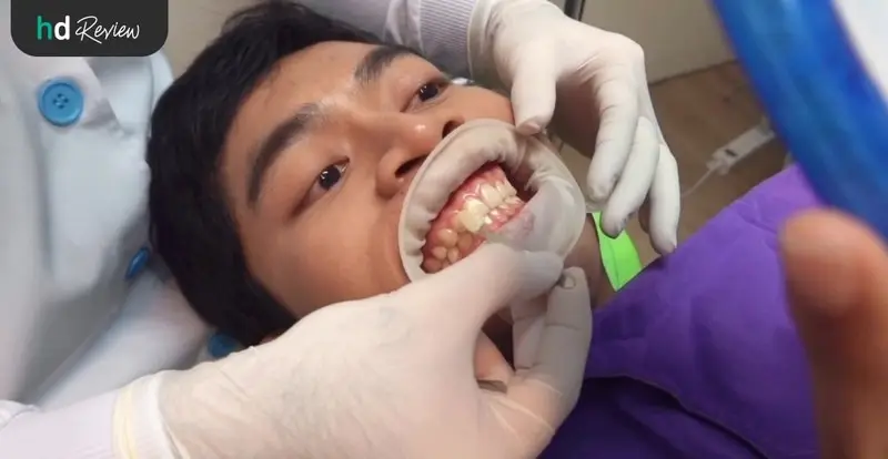 ขั้นตอนการฟอกฟันขาว Let's Smile Dental Clinic