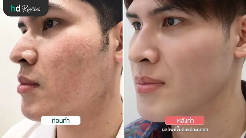 เปรียบเทียบ ก่อนและหลังฉีดหลุมสิว WOW Scar Removal ที่ WOW Clinic