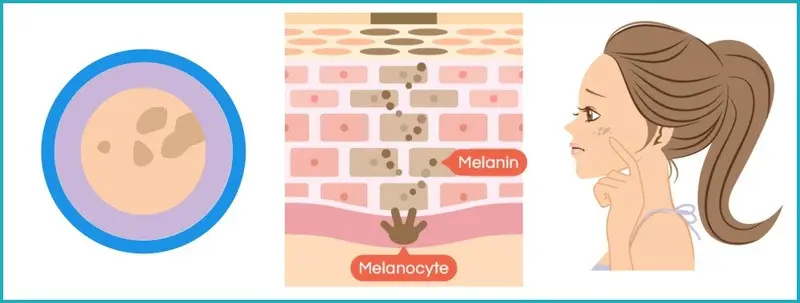 ความไวต่อแสงแดด (Sun Sensitivity)