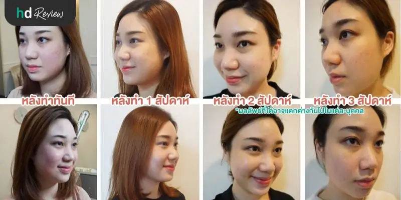 รีวิว Pico Second Laser ลดกระฝ้าบนใบหน้า ที่รัตตินันท์คลินิก
