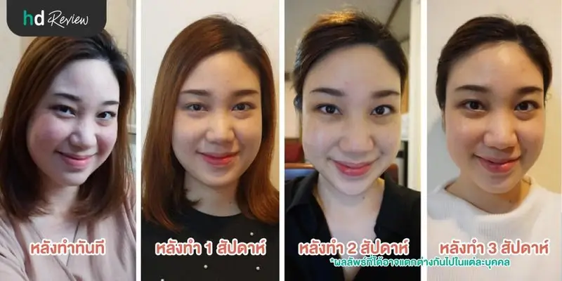 รีวิว Pico Second Laser ลดกระฝ้าบนใบหน้า ที่รัตตินันท์คลินิก