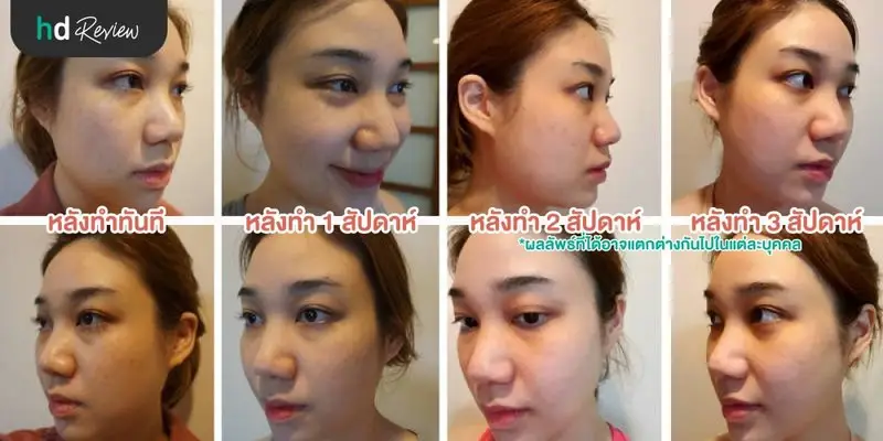 รีวิว Pico Second Laser ลดกระฝ้าบนใบหน้า ที่รัตตินันท์คลินิก