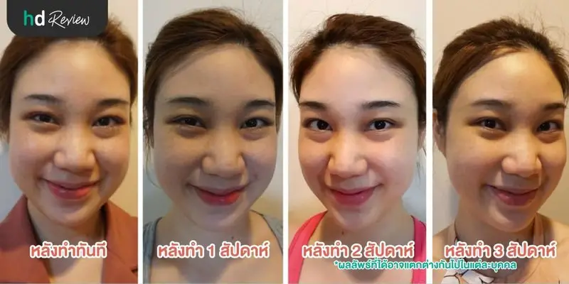 รีวิว Pico Second Laser ลดกระฝ้าบนใบหน้า ที่รัตตินันท์คลินิก