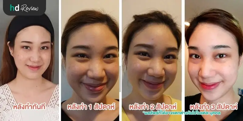 รีวิว Pico Second Laser ลดกระฝ้าบนใบหน้า ที่รัตตินันท์คลินิก