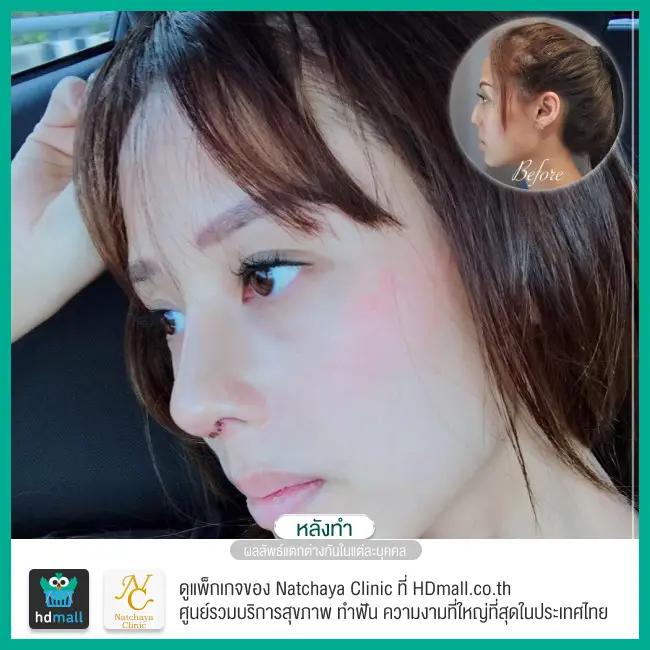 รีวิวศัลยกรรมจมูก ที่ Natchaya Clinic (ณัฐชญา คลินิก)