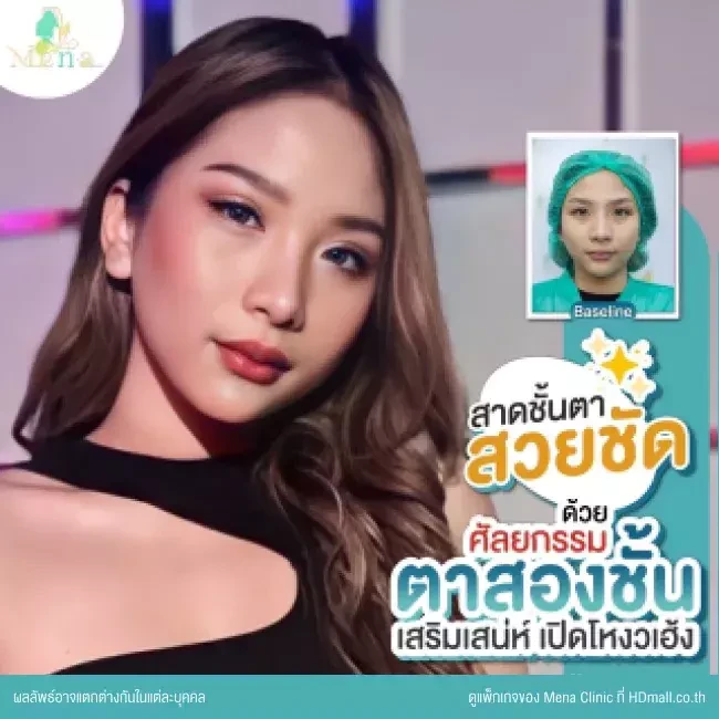 รีวิว ทำตาสองชั้นแบบกรีดยาว พร้อมตกแต่งไขมัน ที่ Mena Clinic