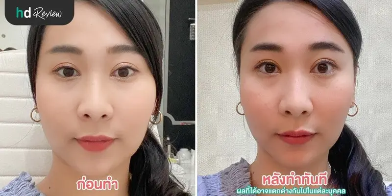 ภาพ Before After หลังทำ Max Lift ที่ Pimtara Estetica Clinic