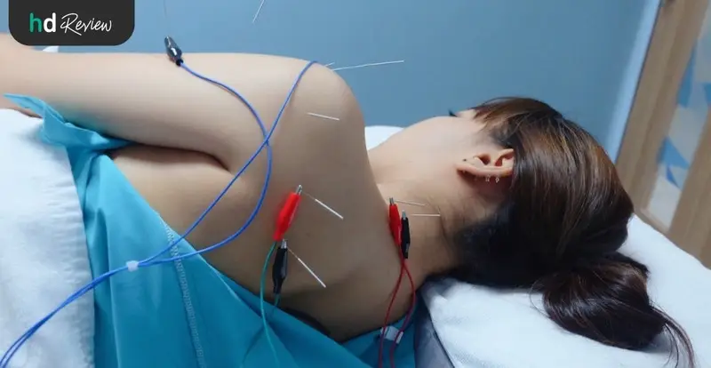 ขั้นตอนการฝังเข็มกระตุ้นไฟฟ้า