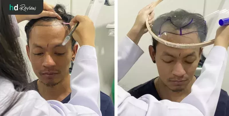 ขั้นตอนการปลูกผม ด้วยเทคนิค FUE ที่ GROW & GLOW Clinic
