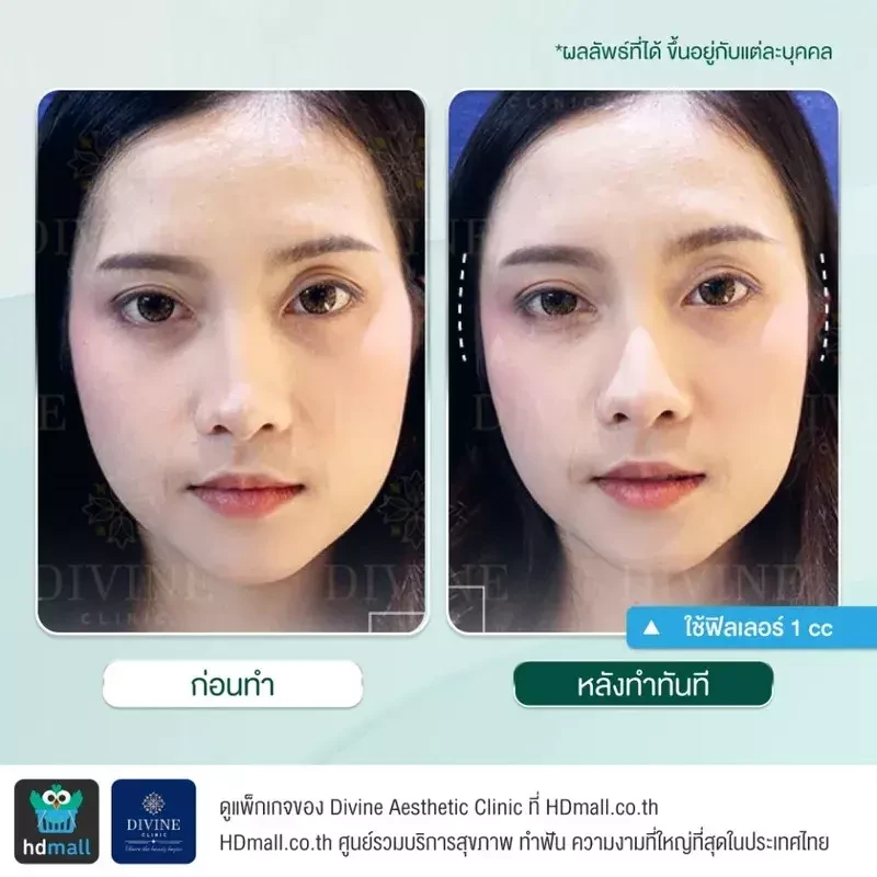 รีวิวฉีดฟิลเลอร์ขมับ ที่ Divine Aesthetic Clinic