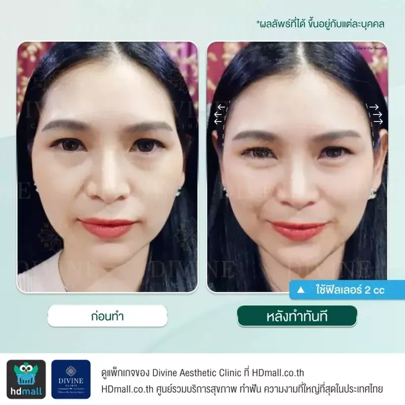 รีวิวฉีดฟิลเลอร์ขมับ ที่ Divine Aesthetic Clinic