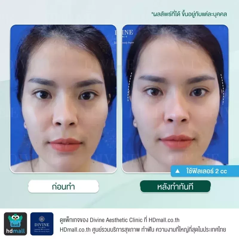 รีวิวฉีดฟิลเลอร์ขมับ ที่ Divine Aesthetic Clinic