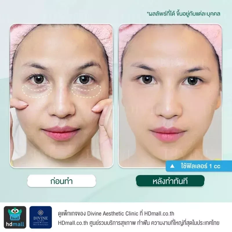 รีวิวฉีดฟิลเลอร์ใต้ตา ที่ Divine Aesthetic Clinic