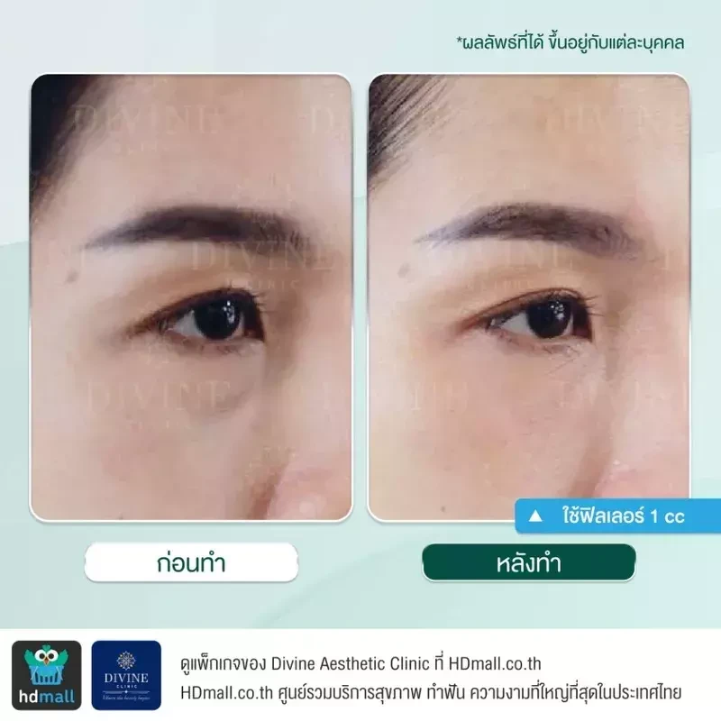 รีวิวฉีดฟิลเลอร์ใต้ตา ที่ Divine Aesthetic Clinic