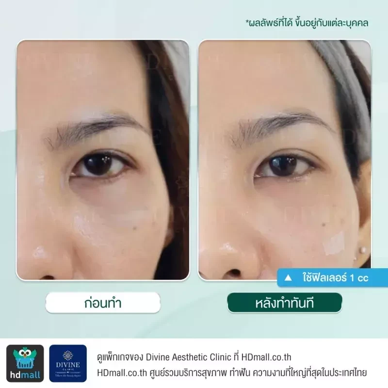 รีวิวฉีดฟิลเลอร์ใต้ตา ที่ Divine Aesthetic Clinic
