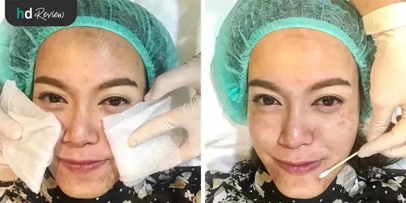 ขั้นตอนการทำเลเซอร์ลดฝ้ากระด้วย Pico Laser ครั้งที่ 2
