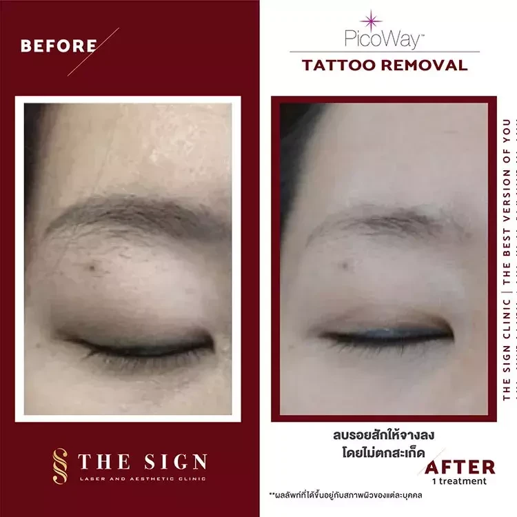 รีวิว PicoWay Tattoo Removal ลบรอยสักที่เดอะไซน์ คลินิก (The Sign Clinic)