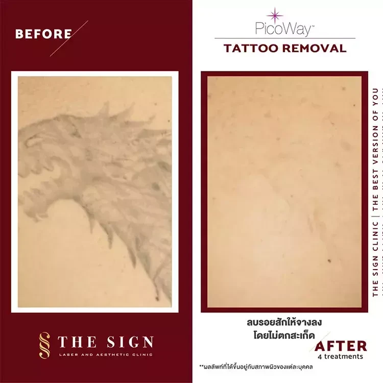 รีวิว PicoWay Tattoo Removal ลบรอยสักที่เดอะไซน์ คลินิก (The Sign Clinic)