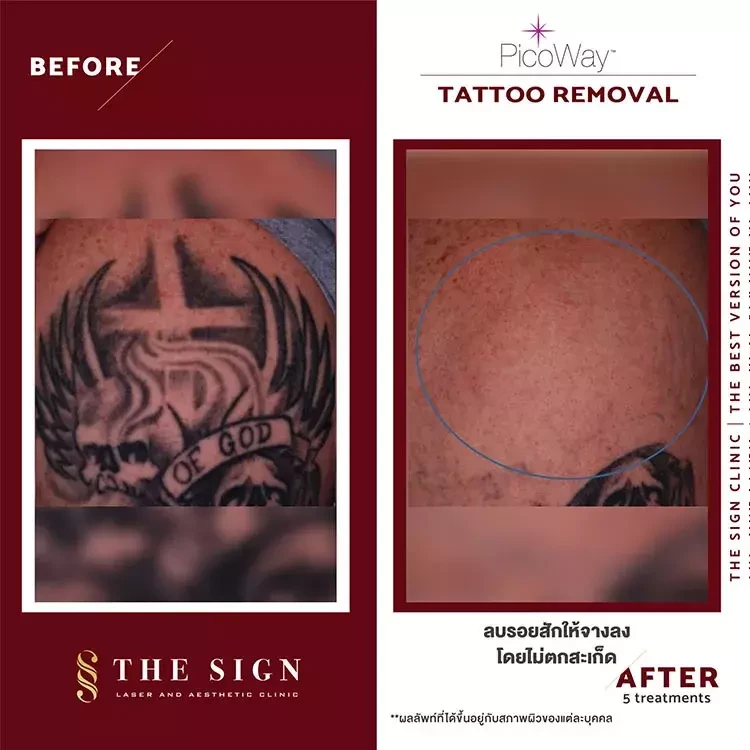 รีวิว PicoWay Tattoo Removal ลบรอยสักที่เดอะไซน์ คลินิก (The Sign Clinic)