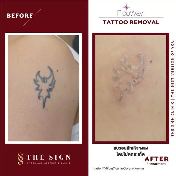 รีวิว PicoWay Tattoo Removal ลบรอยสักที่เดอะไซน์ คลินิก (The Sign Clinic)