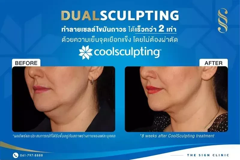 ผลลัพธ์หลังจากการใช้เครื่อง CoolSculpting กำจัดไขมันส่วนเกิน