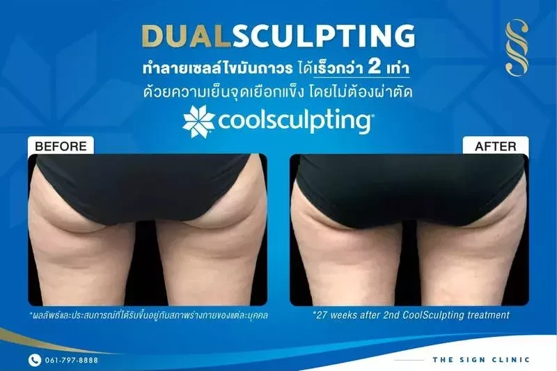 ผลลัพธ์หลังจากการใช้เครื่อง CoolSculpting กำจัดไขมันส่วนเกิน