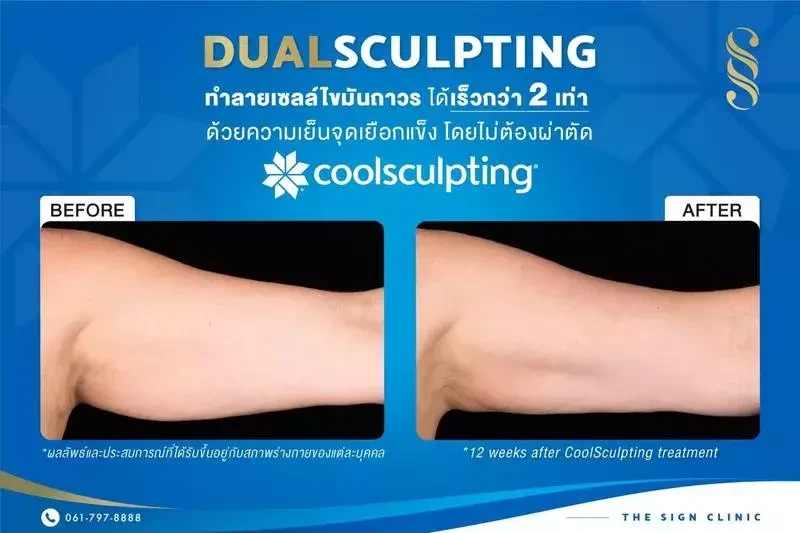 ผลลัพธ์หลังจากการใช้เครื่อง CoolSculpting กำจัดไขมันส่วนเกิน