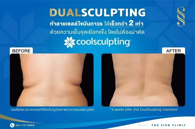 ผลลัพธ์หลังจากการใช้เครื่อง CoolSculpting กำจัดไขมันส่วนเกินบริเวณเอว