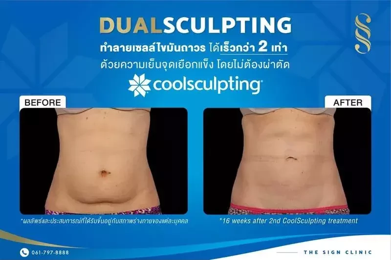 ผลลัพธ์หลังจากการใช้เครื่อง CoolSculpting กำจัดไขมันส่วนเกิน