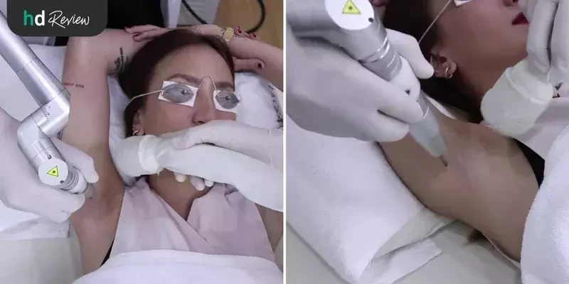 ขั้นตอนการเลเซอร์รักแร้ขาว MedLite C6 ที่ La Grace Clinic