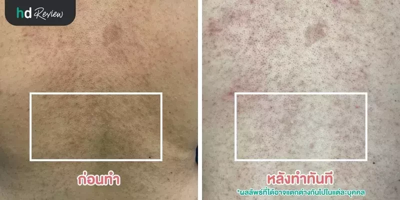 ภาพเปรียบเทียบก่อนและหลังทำการรักษาสิวที่หลัง ที่ Grow & Glow Clinic