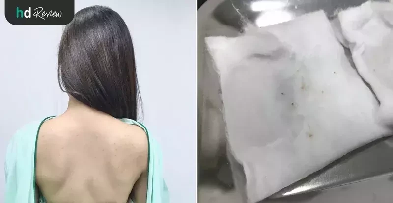 ขั้นตอนการรักษาสิวหลัง ที่ Grow&Glow Clinic