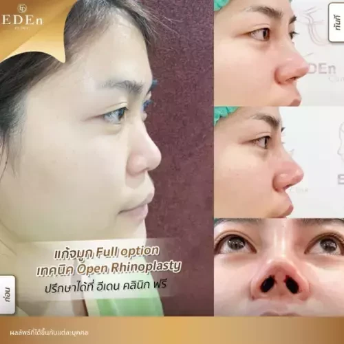 รีวิว เสริมจมูกแบบ Open เชียงใหม่ ที่ E-Den Clinic