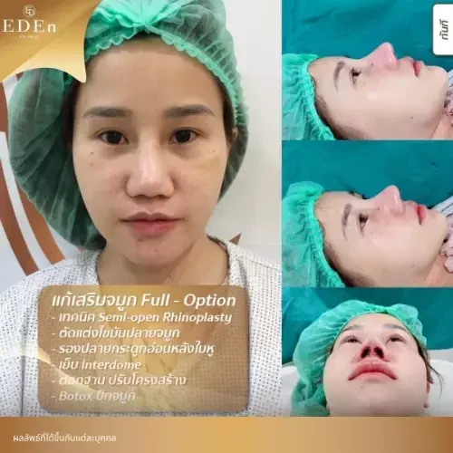 รีวิว เสริมจมูกแบบ Open เชียงใหม่ ที่ E-Den Clinic