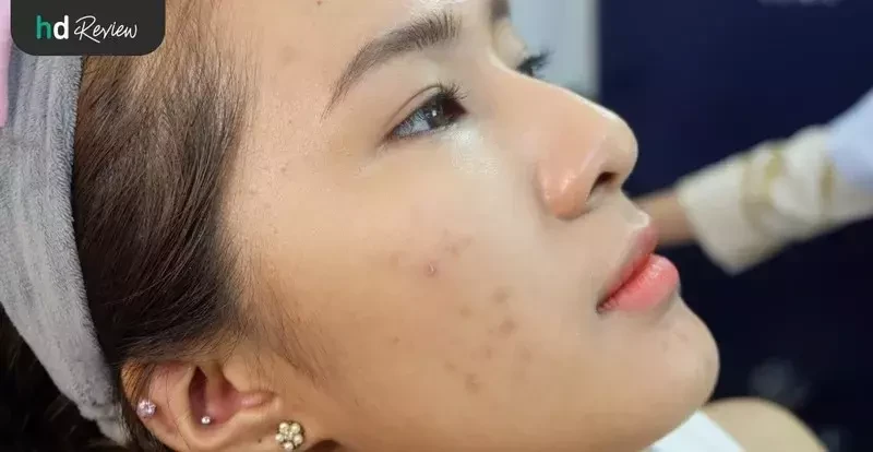 ภาพก่อนฉีดลดรอยสิว ฝ้า จุดด่างดำ ที่ Divine Aesthetic Clinic