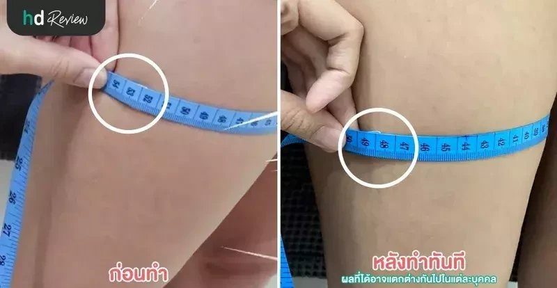 Before After สลายไขมันต้นขา ด้วย Cool Slimming ที่ Levince Clinic