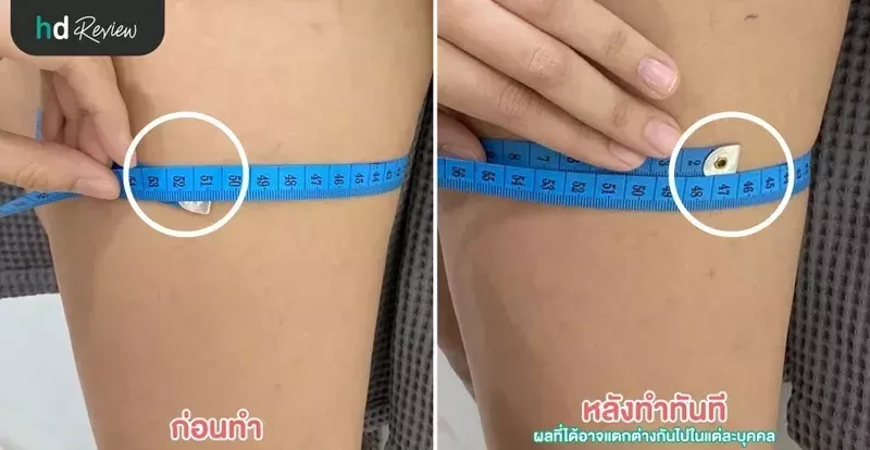 Before After สลายไขมันต้นขา ด้วย Cool Slimming ที่ Levince Clinic