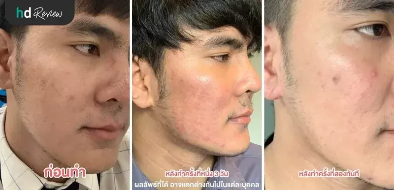 ภาพเปรียบเทียบ Before After