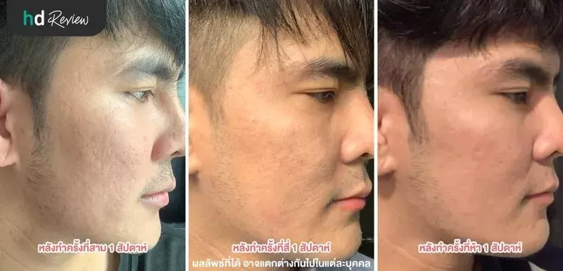 ภาพเปรียบเทียบ Before After
