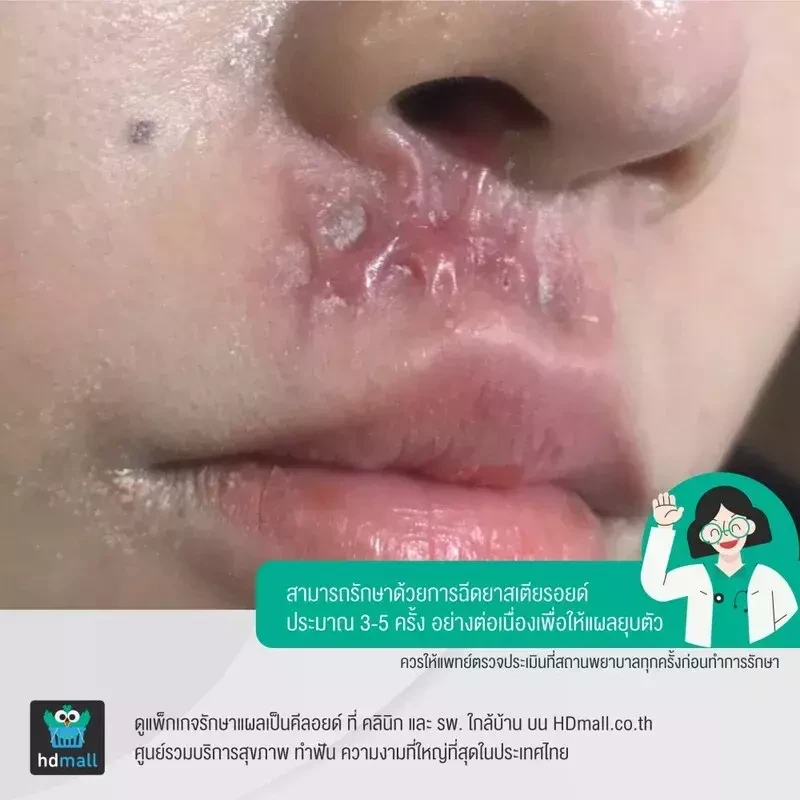 แผลคีลอยด์ที่ควรฉีดยาสเตียรอยด์รักษาคีลอยด์